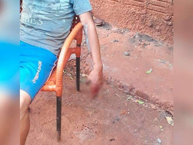 Menino perde os dedos em explos&atilde;o de granada da pol&iacute;cia ap&oacute;s conflito