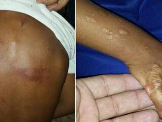 Criança de 4 anos torturada pela mãe ficou 12 horas sem socorro Criança de 4 anos torturada pela mãe ficou 12 horas sem socorro