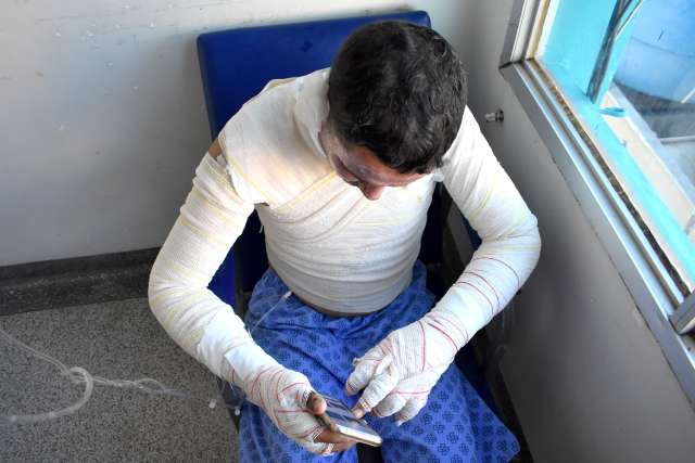 Com 45% do corpo queimado, Anderson alerta para os cuidados ao ficar em casa