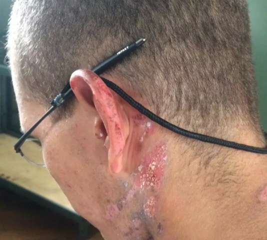 Sargento joga &aacute;lcool gel e ateia fogo em recruta dentro de quartel da Capital