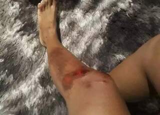 Moradora relata que se enroscou em linha de pipa e caiu de motocicleta (Foto: Direto das ruas)