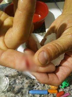 Moradora enviou foto de dedo cortado por linha de pipa. (Foto: Direto das Ruas)