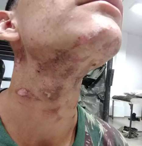 Sargento que ateou fogo em recruta vai responder por &ldquo;les&atilde;o grave&rdquo; 