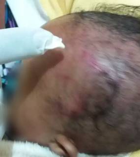 Hematoma na cabeça descoberto após banho (Foto/Divulgação)