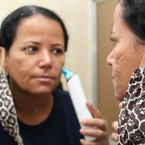 "Maskne": veja o que fazer para evitar a acne causada pelo uso de máscara 