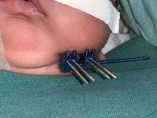 Dispositivo instalado na mandíbula do bebezinho. (Foto: Santa Casa) 