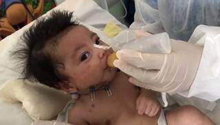 Nascido com síndrome rara, Erick aprende a mamar após cirurgia Nascido com síndrome rara, Erick aprende a mamar após cirurgia