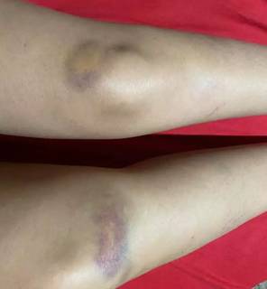 Marcas nos dois joelhos da jovem, de 22 anos; namorado, de 41 anos, é suspeito de agressão (Foto: Reprodução/Facebook)