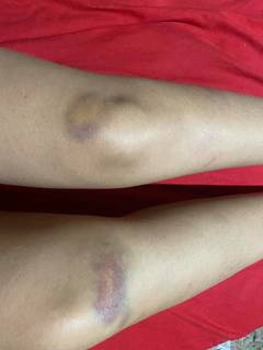 Nos joelhos, as marcas por ter sido arrastada, segundo denúncia da estudante (Foto/Divulgação)