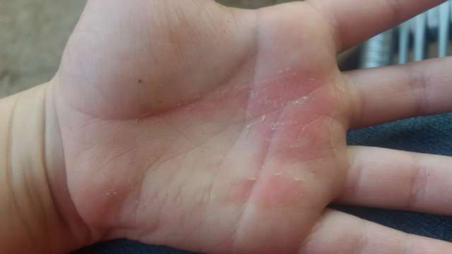 Crian&ccedil;a tenta pegar Toddynho e tem as m&atilde;os queimadas pela m&atilde;e