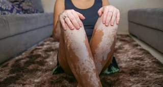 Vitiligo é uma doença não-contagiosa, onde a pena despigmenta na forma de manchas. (Foto: Paulo Francis)