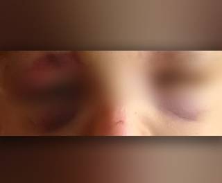 Crian&ccedil;a vai para hospital com hematoma nos olhos e pol&iacute;cia investiga pais