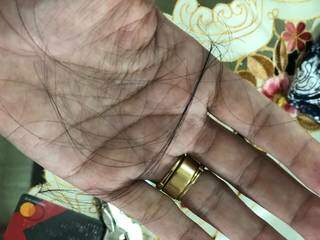 Nas mãos, os cabelos caindo logo após início do tratamento (Foto: Arquivo Pessoal)