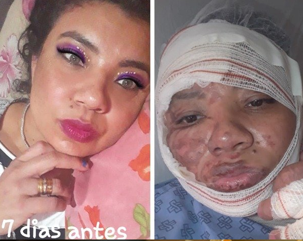 Cantor sertanejo, esposa e cunhada ficam feridos ap&oacute;s acidente com bife na chapa