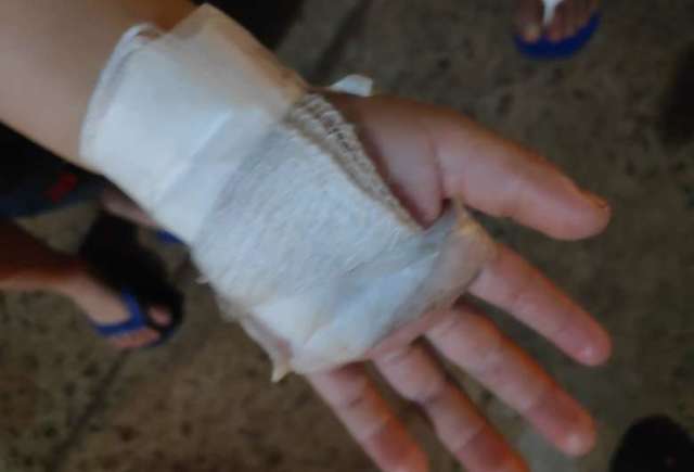 Com corte na m&atilde;o, menino de 3 anos diz que foi ferido com faca pelo padrasto