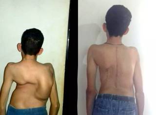 Lucas antes e depois da cirurgia que corrigiu sua escoliose (Foto: Arquivo Pessoa)