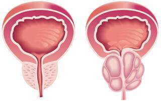 À esquerda, próstata com características normais; à direita, órgão com hiperplasia prostática (Foto: Reprodução/Internet)