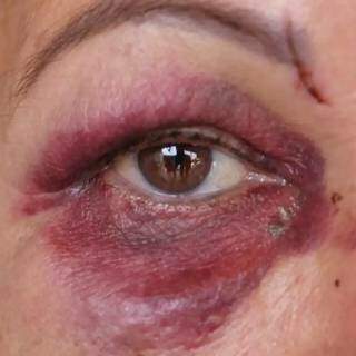 Roxo ao redor do olho de idosa mostra ferimentos um dia depois da agressão. (Foto: Paulo Francis)