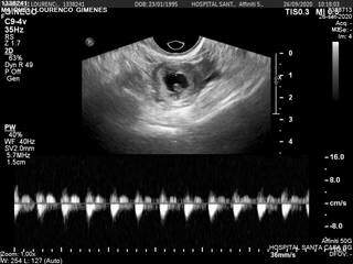 Exame de ultrassom apontou que óvulo fertilizado havia se implantado na trompa esquerda da paciente. (Foto: Direto das Ruas)