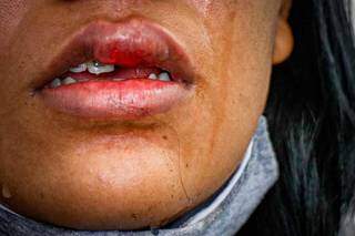 &#34;Quebrou o celular na minha cara&#34;, conta. Vítima mostra dente quebrado pela agressão. (Foto: Henrique Kawaminami)