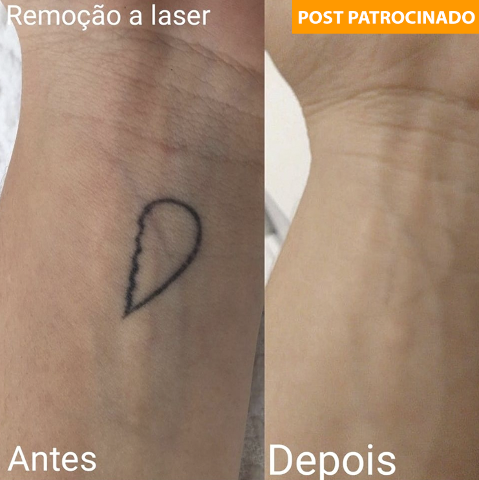 Estúdio Micro abre nova turma para curso de remoção a laser