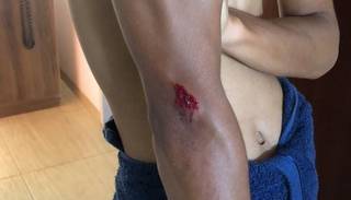 Adolescente caiu no chão e com o impacto teve ferimentos nos braços, pernas e costas. (Foto: Direto das Ruas)