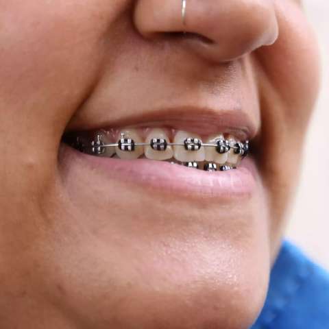 Meninada usa at&eacute; fio de vassoura para ter aparelho nos dentes