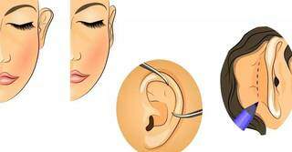 Otoplastia é a cirurgia de correção estética das orelhas; na harmonização, porém, não há uso da &#34;faca&#34; (Foto: Reprodução)