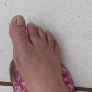 O inchaço no pé de Rosana após a picada. (Foto: Direto das Ruas)