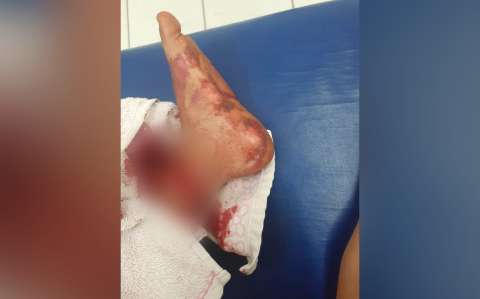 Criança de 5 anos rompe quatro tendões após ser atingida por linha chilena 