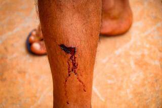 Morador que teve a perna atingida por bala de borracha (Foto: Henrique Kawaminami) 
