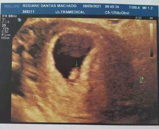 Vacinada, filha perdeu m&atilde;e com covid, mas viu vida seguir em gravidez inesperada