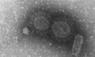 Imagem do Instituto Adolf Lutz mostra lesões  provocadas pelo vírus da covid-19. (Foto: Divulgação)