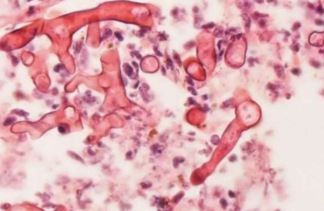MS confirma primeiro caso de fungo negro, em paciente de Campo Grande