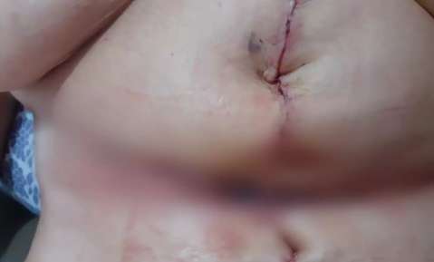 Paciente denuncia erro médico durante abdominoplastia 