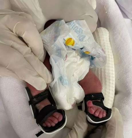 Beb&ecirc; com apenas 13 dias de vida recebe &oacute;rtese feita em impressora 3D 