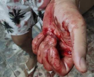 Proprietário de motel com a mão ensanguentada após ferimento em assalto. (Foto: Adilson Domingos)