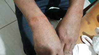 Marceneiro ficou com marcas após ter mãos amarradas com cinto. (Foto: Arquivo Pessoal)
