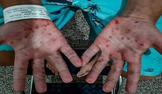 Crianças acometidas pela síndrome desenvolvem bolhas nas mãos e pés. (Foto: Governo de MS)