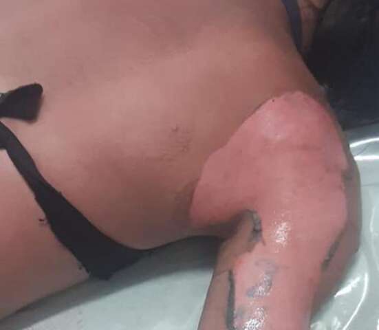 Preso que teve corpo queimado iniciou inc&ecirc;ndio em pres&iacute;dio na fronteira