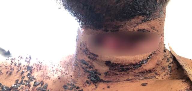 Homem enterrado vivo consegue escapar da cova mesmo com pesco&ccedil;o cortado