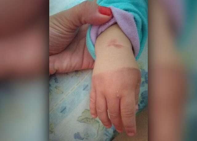 M&atilde;e denuncia bab&aacute; por maus-tratos ap&oacute;s beb&ecirc; ter a m&atilde;o queimada