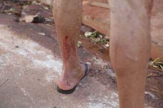 Uma das vítimas ficou com a perna ferida após o atropelamento. (Foto: Kísie Ainoã)
