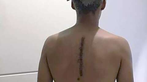 Após ser atropelado, jovem passa por duas cirurgias na coluna