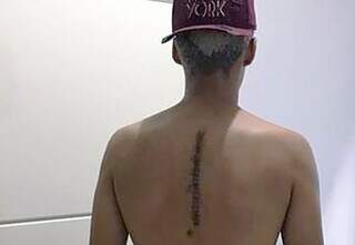 Paciente com cicatriz nas costas após cirurgia. (Foto: Divulgação | Santa Casa)