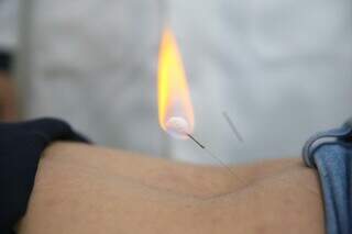 Técnica Hot Needling alivia a dor muscular, por meio do calor do fogo. (Foto: Paulo Francis)