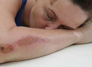 Mulher mostra ferimentos no braço e no olho, cena comum registrada na Deam. (Foto: Kisie Aioã)