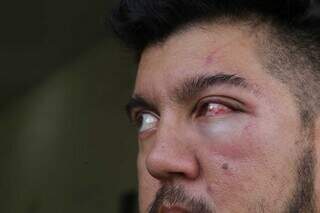 Filho do dono do restaurante ficou com inchaço e hematomas no olho. (Foto: Kísie Ainoã)