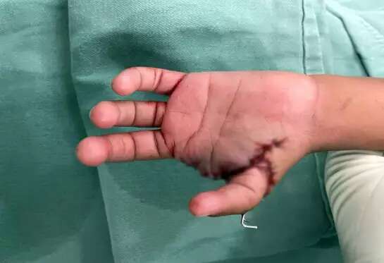 Menino de 6 anos passa por transplante e ganha novo polegar