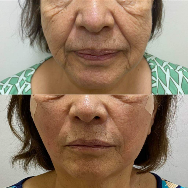 Sem cirurgia, fio de sustentação devolve sua juventude - Conteúdo